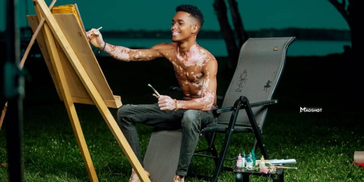 A Courageous Walk To Fame: Meet The Model Changing Minds About Vitiligo In Uganda